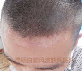 19岁男生额头白斑3年