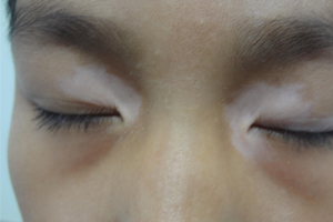 眼角白癜风激光治疗几次能够治好