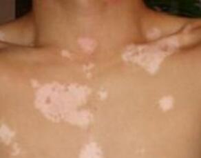 胸部白癜风不及时治疗会怎么样