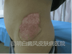 男孩侧髂部白斑两年,在我院成功康复