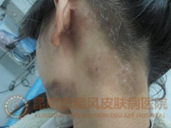 17岁女孩多块白斑,在我院成功康复