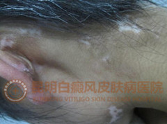 17岁女孩多块白斑,在我院成功康复