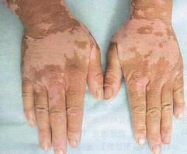 泛发型白癜风怎样护理