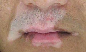 面部为什么会长白癜风