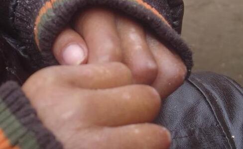 怎么治疗手部的白癜风