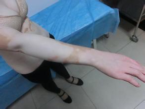 节段型白癜风患者注意哪些事