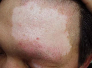 面部为什么会患上白癜风