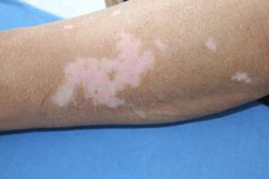 白癜风白斑的4种特性有哪些?