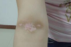 白癜风早期能康复吗